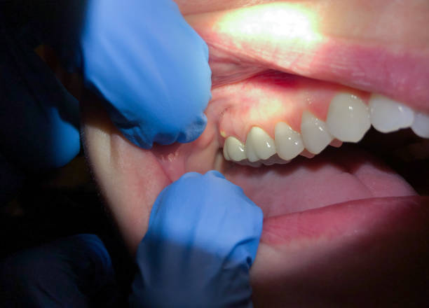 Best Emergency Treatment for Dental Infections or Abscesses in East Hills, NY